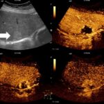 간 혈관종 원인, 증상, 예방, 좋은 음식