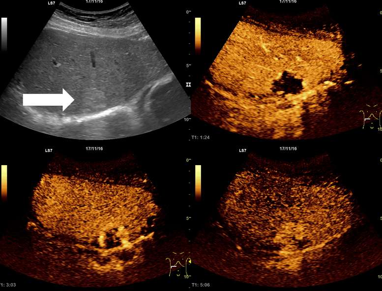 간 혈관종 원인, 증상, 예방, 좋은 음식