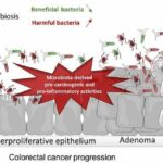 대장암 원인, 증상, 예방 및 좋은 음식