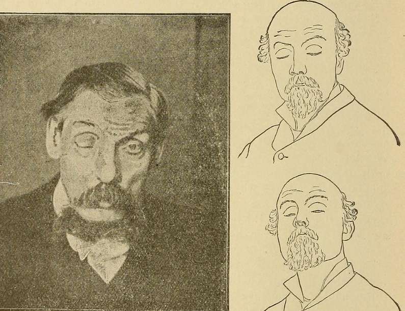 안면 신경 마비