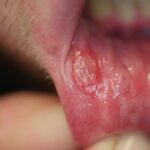 구내염 원인부터 종류, 전염, 예방, 좋은 음식까지