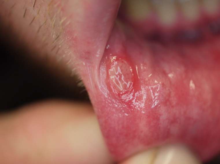 구내염 원인부터 종류, 전염, 예방, 좋은 음식까지