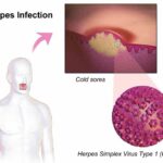 헤르페스 2형 원인과 증상 및 예방