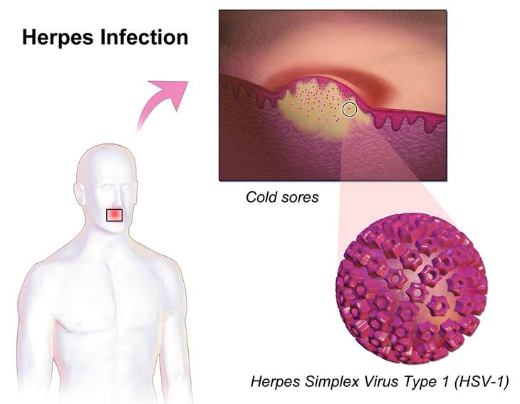 헤르페스 2형 원인과 증상 및 예방