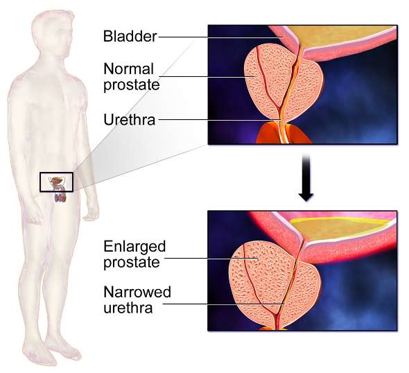전립선 비대증 원인부터 증상 및 예방