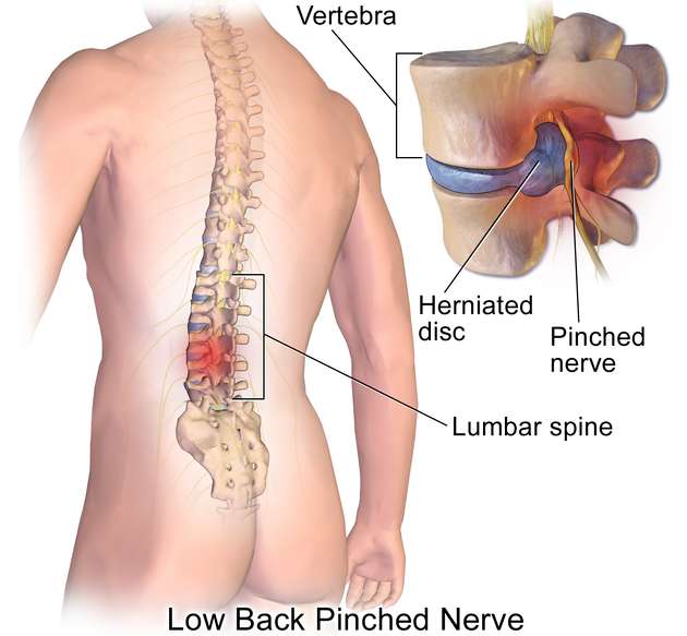 허리 디스크 원인, 증상, 예방, 운동 및 좋은 음식