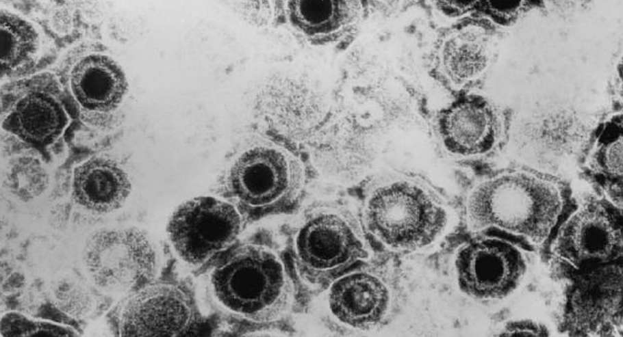 2형 헤르페스 진단