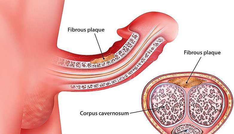 전립선 비대증 증상 