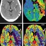 뇌경색 원인에서부터 전조증상 및 후유증, 예방