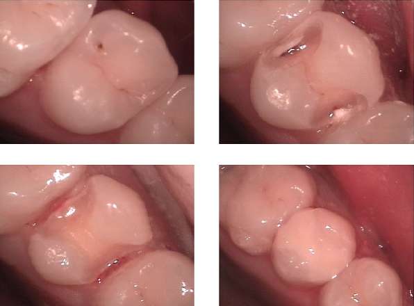 충치 레진 및 구강 관리 팁