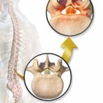 척추 협착증 원인, 증상 및 예방과 좋은 음식