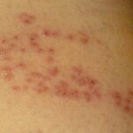 대상포진 원인, 증상, 전염 및 예방법