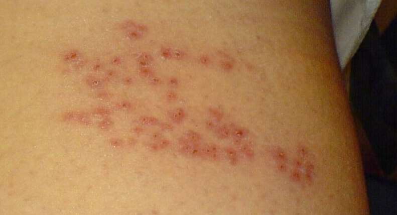 대상포진 원인, 증상, 전염 및 예방법