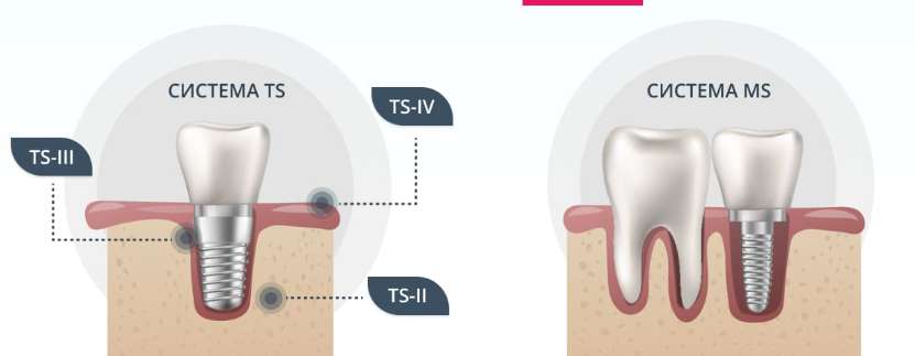 오스템 임플란트