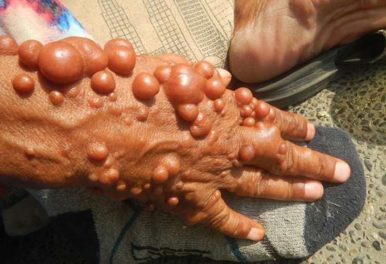 신경섬유종 원인, 증상 및 좋은 음식