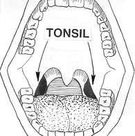 편도부었을때 증상