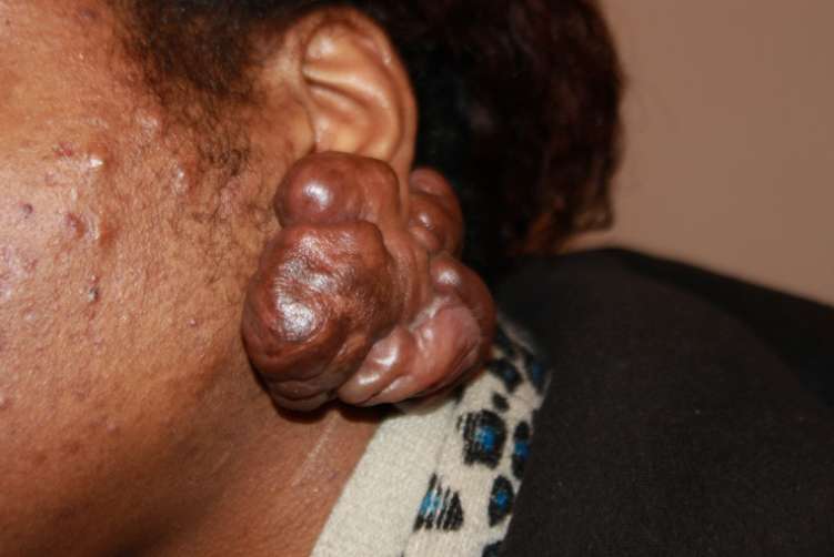 신경섬유종 증상