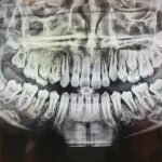 충치 레진 보험적용 범위