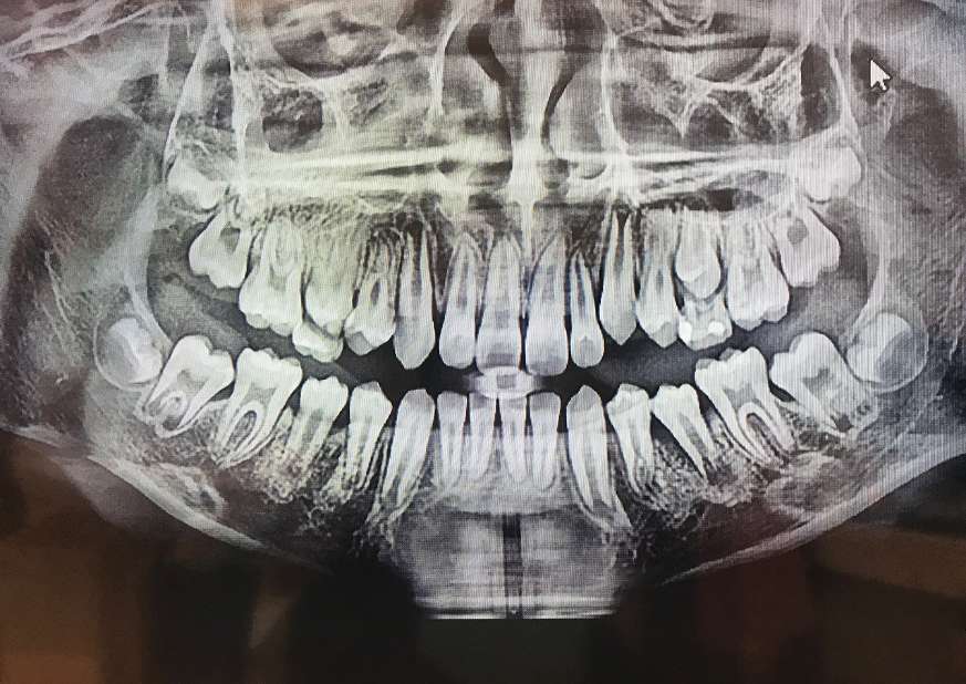 충치 레진 보험적용 범위