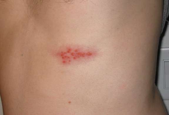 대상포진 증상1