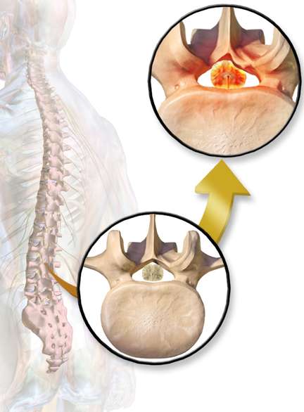 허리 협착증 원인부터 증세(증상) 및 운동방법