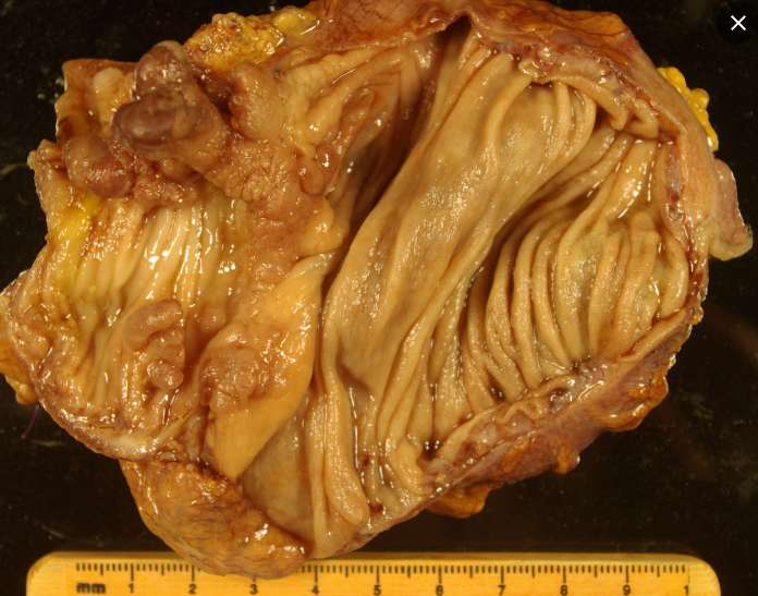 신경섬유종 증상
