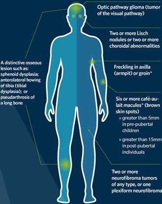 신경섬유종증의 유형