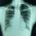 폐결절 원인부터 증상, 통증, 폐암 확률