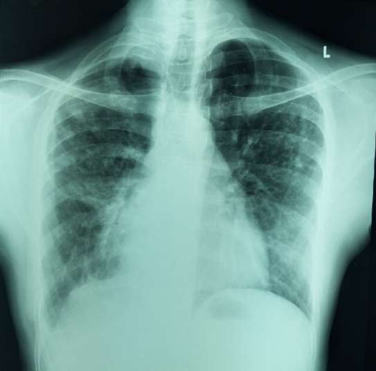 폐결절 원인부터 증상, 통증, 폐암 확률