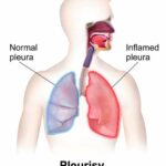 늑막염(흉막염) 원인, 증상 및 예방과 좋은 음식