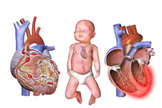 가와사키병 원인, 증상에서부터 전염