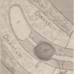 맹장염 원인, 증상, 치료 및 예방