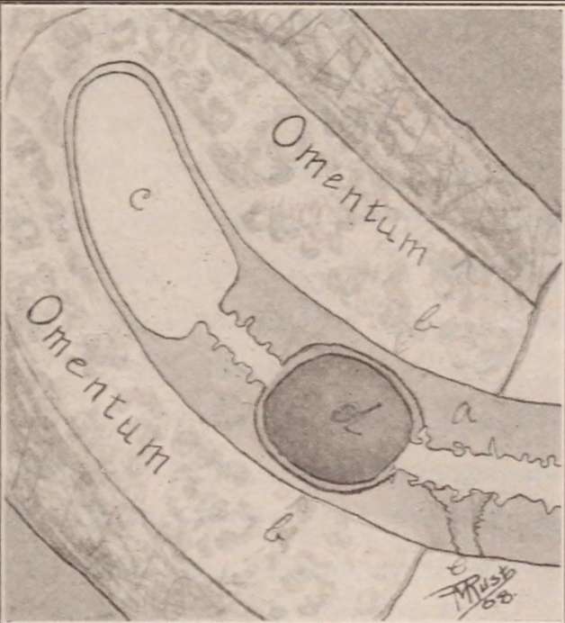 맹장염 원인, 증상, 치료 및 예방
