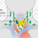 갑상선암의 원인과 증상, 종류, 예방