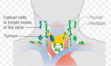 갑상선암의 원인과 증상, 종류, 예방