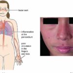 루프스병(루푸스) 원인, 증상, 예방법 숙지하셨나요?