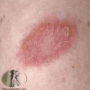 장미색비강진 원인