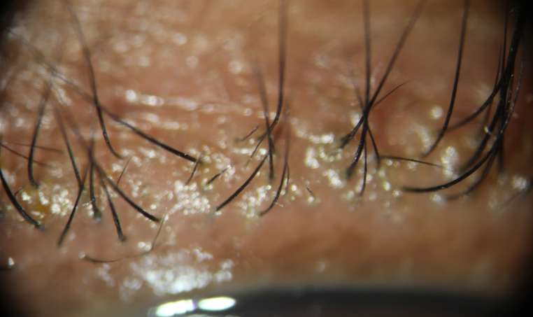 모낭염 증상 - 고름으로 가득 찬 병변