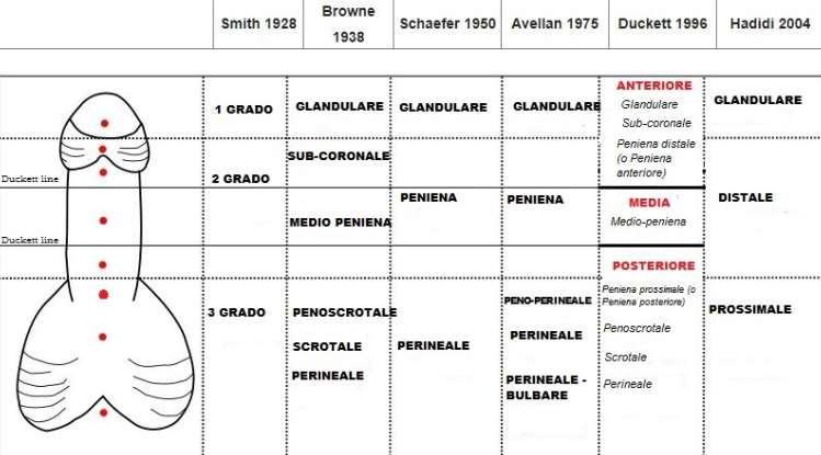 요도하열 증상, 원인, 임신, 진단 및 치료, 좋은 음식 한방에 정리