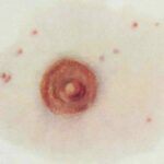 체리 혈관종의 원인, 증상 및 치료 옵션 및 보험