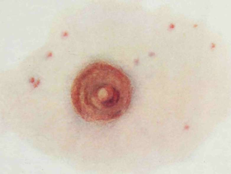 체리 혈관종의 원인, 증상 및 치료 옵션 및 보험