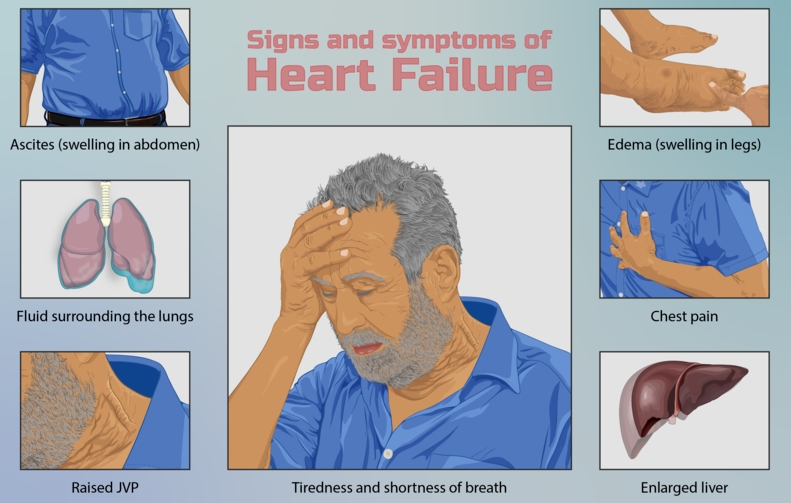 심부전 증상, 원인, 진단, 예방 및 좋은 음식 한방에 정리