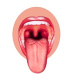 혀암(설암) 원인, 증상, 통증 및 예방, 좋은 음식