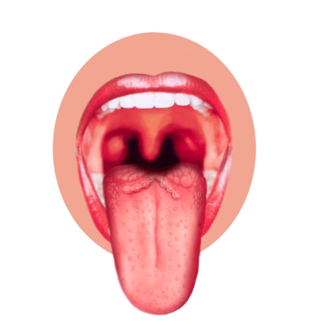 혀암(설암) 원인, 증상, 통증 및 예방, 좋은 음식