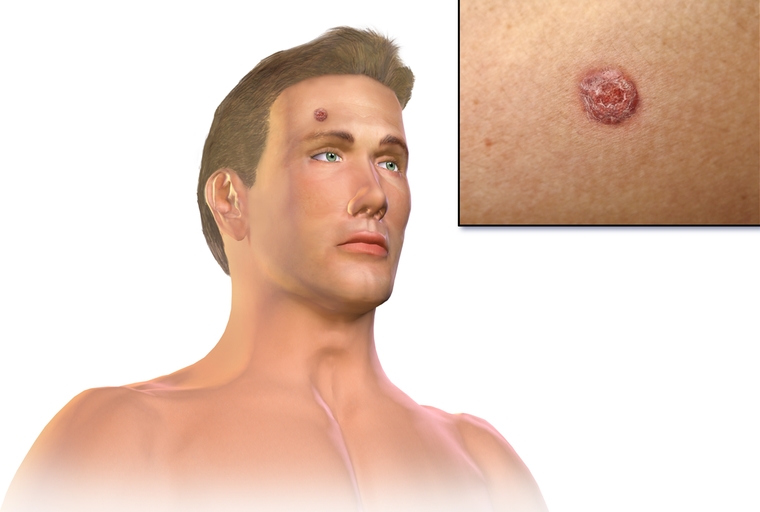 피부 암 원인, 증상 및 종류에 대한 진실 확인하기