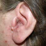 귀 염증 증상에서 원인, 두통, 턱, 치료 및 좋은 음식한방에 정리