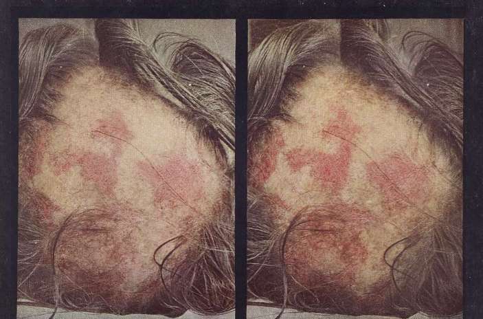 일반적인 루푸스(루프스병) 증상