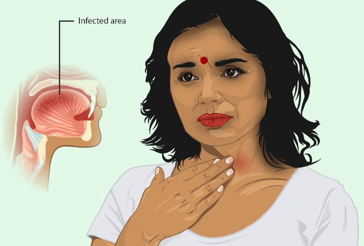 인두염의 원인, 증상, 전염, 예방 및 좋은 음식 가이드 정리