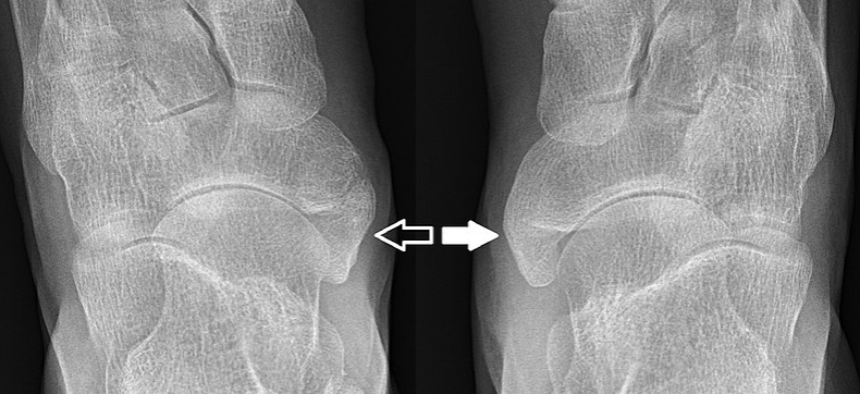 부주상골 증후군 증상 및 식별