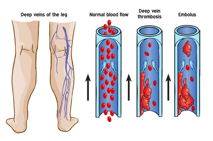 어린이와 성인을 위한 심부정맥 혈전증 통증설명
